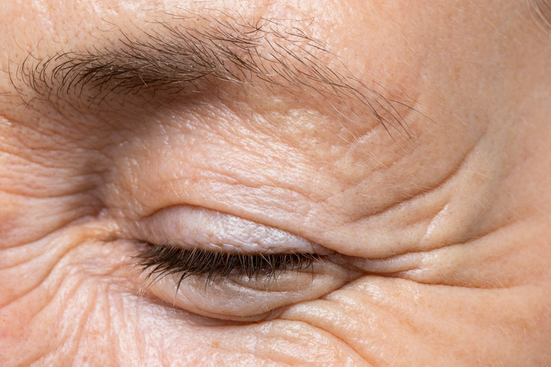 Wrinkles and fine lines